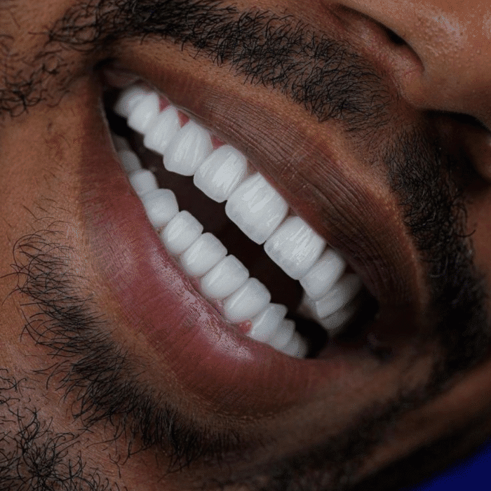 Irrigador Oral Para Lente de Contato Dental - Imagem 4